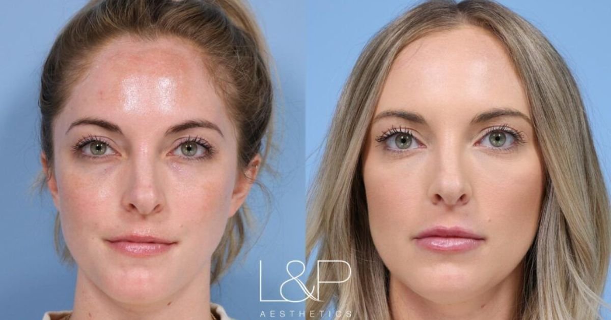 Dermal Fillers Before And After